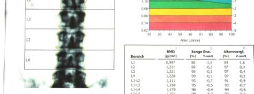 DEXA -Knochendichtemessung